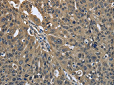 The image on the left is immunohistochemistry of paraffin-embedded Human ovarian cancer tissue using CSB-PA596780(PRDX6 Antibody) at dilution 1/25, on the right is treated with fusion protein. (Original magnification: ×200)