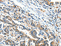 The image on the left is immunohistochemistry of paraffin-embedded Human gastic cancer tissue using CSB-PA596925(BCL2L2 Antibody) at dilution 1/15, on the right is treated with fusion protein. (Original magnification: ×200)