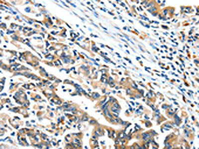 The image on the left is immunohistochemistry of paraffin-embedded Human gastic cancer tissue using CSB-PA596925(BCL2L2 Antibody) at dilution 1/15, on the right is treated with fusion protein. (Original magnification: ×200)