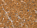 The image on the left is immunohistochemistry of paraffin-embedded Human ovarian cancer tissue using CSB-PA597067(SSTR3 Antibody) at dilution 1/30, on the right is treated with synthetic peptide. (Original magnification: ×200)