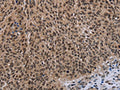 The image on the left is immunohistochemistry of paraffin-embedded Human lung cancer tissue using CSB-PA597470(DLX4 Antibody) at dilution 1/50, on the right is treated with fusion protein. (Original magnification: ×200)