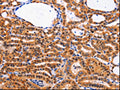 The image on the left is immunohistochemistry of paraffin-embedded Human thyroid cancer tissue using CSB-PA597701(CDK4 Antibody) at dilution 1/10, on the right is treated with fusion protein. (Original magnification: ×200)