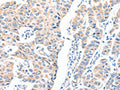 The image on the left is immunohistochemistry of paraffin-embedded Human breast cancer tissue using CSB-PA597708(ADCK1 Antibody) at dilution 1/40, on the right is treated with fusion protein. (Original magnification: ×200)