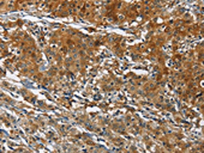 The image on the left is immunohistochemistry of paraffin-embedded Human gastic cancer tissue using CSB-PA597777(CAST Antibody) at dilution 1/70, on the right is treated with fusion protein. (Original magnification: ×200)