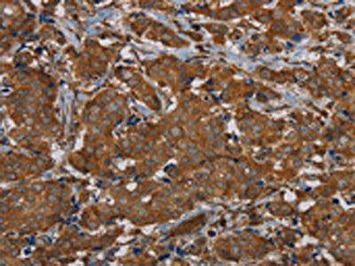 The image on the left is immunohistochemistry of paraffin-embedded Human breast cancer tissue using CSB-PA597940(PIK3CD Antibody) at dilution 1/20, on the right is treated with synthetic peptide. (Original magnification: ×200)