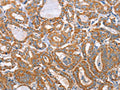 The image on the left is immunohistochemistry of paraffin-embedded Human thyroid cancer tissue using CSB-PA598045(MTMR7 Antibody) at dilution 1/40, on the right is treated with fusion protein. (Original magnification: ×200)