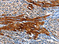 The image on the left is immunohistochemistry of paraffin-embedded Human liver cancer tissue using CSB-PA598136(AOX1 Antibody) at dilution 1/65, on the right is treated with fusion protein. (Original magnification: ×200)