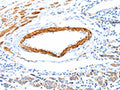 The image on the left is immunohistochemistry of paraffin-embedded Human colon cancer tissue using CSB-PA598310(IMMT Antibody) at dilution 1/12, on the right is treated with fusion protein. (Original magnification: ×200)