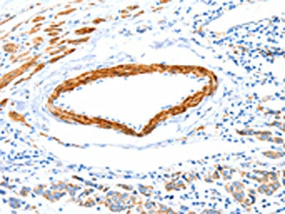 The image on the left is immunohistochemistry of paraffin-embedded Human colon cancer tissue using CSB-PA598310(IMMT Antibody) at dilution 1/12, on the right is treated with fusion protein. (Original magnification: ×200)