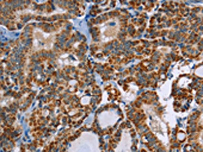 The image on the left is immunohistochemistry of paraffin-embedded Human thyroid cancer tissue using CSB-PA598314(ABCB1 Antibody) at dilution 1/30, on the right is treated with synthetic peptide. (Original magnification: ×200)