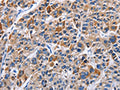 The image on the left is immunohistochemistry of paraffin-embedded Human liver cancer tissue using CSB-PA598713(ENPP5 Antibody) at dilution 1/40, on the right is treated with fusion protein. (Original magnification: ×200)