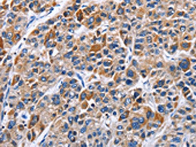 The image on the left is immunohistochemistry of paraffin-embedded Human liver cancer tissue using CSB-PA598713(ENPP5 Antibody) at dilution 1/40, on the right is treated with fusion protein. (Original magnification: ×200)