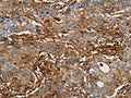 The image on the left is immunohistochemistry of paraffin-embedded Human gastic cancer tissue using CSB-PA598794(ICAM1 Antibody) at dilution 1/50, on the right is treated with fusion protein. (Original magnification: ×200)