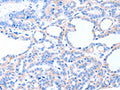 The image on the left is immunohistochemistry of paraffin-embedded Human thyroid cancer tissue using CSB-PA598870(ACAD8 Antibody) at dilution 1/20, on the right is treated with fusion protein. (Original magnification: ×200)
