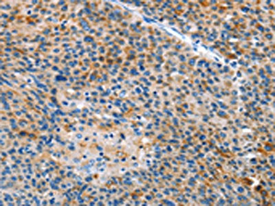 The image on the left is immunohistochemistry of paraffin-embedded Human liver cancer tissue using CSB-PA598875(ALS2 Antibody) at dilution 1/25, on the right is treated with fusion protein. (Original magnification: ×200)