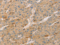 The image on the left is immunohistochemistry of paraffin-embedded Human liver cancer tissue using CSB-PA599200(TNFSF13 Antibody) at dilution 1/20, on the right is treated with synthetic peptide. (Original magnification: ×200)