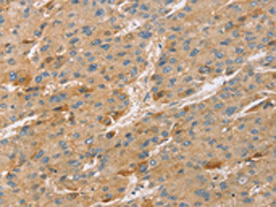 The image on the left is immunohistochemistry of paraffin-embedded Human liver cancer tissue using CSB-PA599200(TNFSF13 Antibody) at dilution 1/20, on the right is treated with synthetic peptide. (Original magnification: ×200)