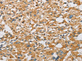 The image on the left is immunohistochemistry of paraffin-embedded Human thyroid cancer tissue using CSB-PA600132(ARHGEF7 Antibody) at dilution 1/40, on the right is treated with fusion protein. (Original magnification: ×200)