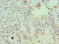 Immunohistochemistry of paraffin-embedded human breast cancer using CSB-PA600854ESR2HU at dilution of 1:100