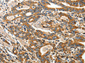 The image on the left is immunohistochemistry of paraffin-embedded Human gastic cancer tissue using CSB-PA601738(ANGPTL1 Antibody) at dilution 1/40, on the right is treated with fusion protein. (Original magnification: ×200)