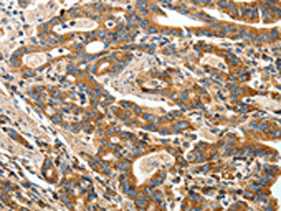 The image on the left is immunohistochemistry of paraffin-embedded Human gastic cancer tissue using CSB-PA601738(ANGPTL1 Antibody) at dilution 1/40, on the right is treated with fusion protein. (Original magnification: ×200)