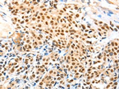 The image on the left is immunohistochemistry of paraffin-embedded Human esophagus cancer tissue using CSB-PA605758(APPL1 Antibody) at dilution 1/70, on the right is treated with fusion protein. (Original magnification: ×200)
