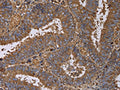 The image on the left is immunohistochemistry of paraffin-embedded Human colon cancer tissue using CSB-PA607012(FADS1 Antibody) at dilution 1/60, on the right is treated with fusion protein. (Original magnification: ×200)