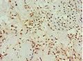 Immunohistochemistry of paraffin-embedded human breast cancer using CSB-PA613265ESR1HU at dilution of 1:100