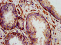 IHC image of CSB-PA613378LA01HU diluted at 1:1400 and staining in paraffin-embedded human prostate cancer performed on a Leica BondTM system. After dewaxing and hydration, antigen retrieval was mediated by high pressure in a citrate buffer (pH 6.0). Section was blocked with 10% normal goat serum 30min at RT. Then primary antibody (1% BSA) was incubated at 4°C overnight. The primary is detected by a biotinylated secondary antibody and visualized using an HRP conjugated SP system.