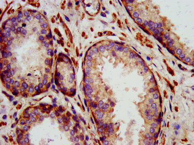 IHC image of CSB-PA613378LA01HU diluted at 1:1400 and staining in paraffin-embedded human prostate cancer performed on a Leica BondTM system. After dewaxing and hydration, antigen retrieval was mediated by high pressure in a citrate buffer (pH 6.0). Section was blocked with 10% normal goat serum 30min at RT. Then primary antibody (1% BSA) was incubated at 4°C overnight. The primary is detected by a biotinylated secondary antibody and visualized using an HRP conjugated SP system.