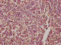 IHC image of CSB-PA613486NA01HU diluted at 1:300 and staining in paraffin-embedded human glioma performed on a Leica BondTM system. After dewaxing and hydration, antigen retrieval was mediated by high pressure in a citrate buffer (pH 6.0). Section was blocked with 10% normal goat serum 30min at RT. Then primary antibody (1% BSA) was incubated at 4&deg;C overnight. The primary is detected by a biotinylated secondary antibody and visualized using an HRP conjugated SP system.