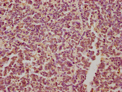 IHC image of CSB-PA613486NA01HU diluted at 1:300 and staining in paraffin-embedded human glioma performed on a Leica BondTM system. After dewaxing and hydration, antigen retrieval was mediated by high pressure in a citrate buffer (pH 6.0). Section was blocked with 10% normal goat serum 30min at RT. Then primary antibody (1% BSA) was incubated at 4&deg;C overnight. The primary is detected by a biotinylated secondary antibody and visualized using an HRP conjugated SP system.