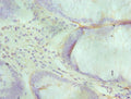 Immunohistochemistry of paraffin-embedded human colon cancer using CSB-PA614439ESR1HU at dilution of 1:100