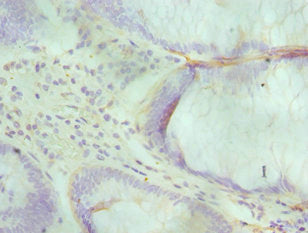 Immunohistochemistry of paraffin-embedded human colon cancer using CSB-PA614439ESR1HU at dilution of 1:100