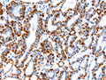 The image on the left is immunohistochemistry of paraffin-embedded Human thyroid cancer tissue using CSB-PA614749(ACAA2 Antibody) at dilution 1/20, on the right is treated with fusion protein. (Original magnification: ×200)