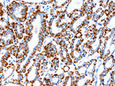 The image on the left is immunohistochemistry of paraffin-embedded Human thyroid cancer tissue using CSB-PA614749(ACAA2 Antibody) at dilution 1/20, on the right is treated with fusion protein. (Original magnification: ×200)