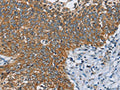 The image on the left is immunohistochemistry of paraffin-embedded Human cervical cancer tissue using CSB-PA614837(ANKHD1 Antibody) at dilution 1/40, on the right is treated with fusion protein. (Original magnification: ×200)
