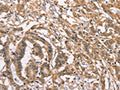 The image on the left is immunohistochemistry of paraffin-embedded Human colon cancer tissue using CSB-PA614951(PEBP1 Antibody) at dilution 1/40, on the right is treated with fusion protein. (Original magnification: ×200)