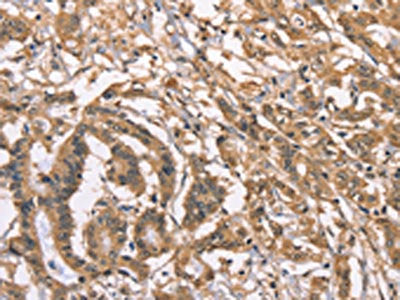 The image on the left is immunohistochemistry of paraffin-embedded Human colon cancer tissue using CSB-PA614951(PEBP1 Antibody) at dilution 1/40, on the right is treated with fusion protein. (Original magnification: ×200)