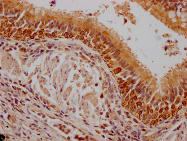 IHC image of CSB-PA614990LA01HU diluted at 1:200 and staining in paraffin-embedded human lung cancer performed on a Leica BondTM system. After dewaxing and hydration, antigen retrieval was mediated by high pressure in a citrate buffer (pH 6.0). Section was blocked with 10% normal goat serum 30min at RT. Then primary antibody (1% BSA) was incubated at 4°C overnight. The primary is detected by a Goat anti-rabbit polymer IgG labeled by HRP and visualized using 0.05% DAB.