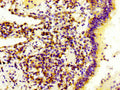 IHC image of CSB-PA615717LA01HU diluted at 1:300 and staining in paraffin-embedded human lung cancer performed on a Leica BondTM system. After dewaxing and hydration, antigen retrieval was mediated by high pressure in a citrate buffer (pH 6.0). Section was blocked with 10% normal goat serum 30min at RT. Then primary antibody (1% BSA) was incubated at 4&deg;C overnight. The primary is detected by a biotinylated secondary antibody and visualized using an HRP conjugated SP system.