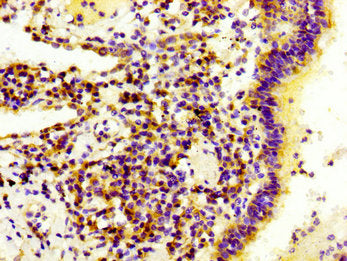 IHC image of CSB-PA615717LA01HU diluted at 1:300 and staining in paraffin-embedded human lung cancer performed on a Leica BondTM system. After dewaxing and hydration, antigen retrieval was mediated by high pressure in a citrate buffer (pH 6.0). Section was blocked with 10% normal goat serum 30min at RT. Then primary antibody (1% BSA) was incubated at 4&deg;C overnight. The primary is detected by a biotinylated secondary antibody and visualized using an HRP conjugated SP system.