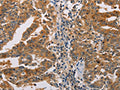 The image on the left is immunohistochemistry of paraffin-embedded Human gastic cancer tissue using CSB-PA616041(ACY1 Antibody) at dilution 1/25, on the right is treated with fusion protein. (Original magnification: ×200)