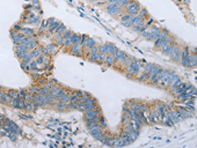 The image on the left is immunohistochemistry of paraffin-embedded Human colon cancer tissue using CSB-PA616184(BDNF Antibody) at dilution 1/20, on the right is treated with fusion protein. (Original magnification: ×200)