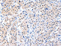 The image on the left is immunohistochemistry of paraffin-embedded Human breast cancer tissue using CSB-PA616530(ADAM15 Antibody) at dilution 1/40, on the right is treated with fusion protein. (Original magnification: ×200)
