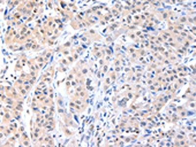 The image on the left is immunohistochemistry of paraffin-embedded Human breast cancer tissue using CSB-PA616530(ADAM15 Antibody) at dilution 1/40, on the right is treated with fusion protein. (Original magnification: ×200)