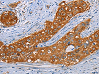 The image on the left is immunohistochemistry of paraffin-embedded Human cervical cancer tissue using CSB-PA616549(MMP1 Antibody) at dilution 1/55, on the right is treated with fusion protein. (Original magnification: ×200)