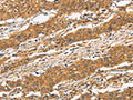 The image on the left is immunohistochemistry of paraffin-embedded Human gastic cancer tissue using CSB-PA616669(CD22 Antibody) at dilution 1/50, on the right is treated with fusion protein. (Original magnification: ×200)