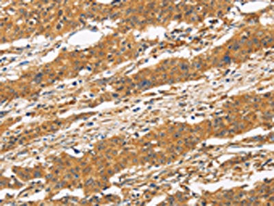 The image on the left is immunohistochemistry of paraffin-embedded Human gastic cancer tissue using CSB-PA616669(CD22 Antibody) at dilution 1/50, on the right is treated with fusion protein. (Original magnification: ×200)