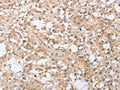 The image on the left is immunohistochemistry of paraffin-embedded Human thyroid cancer tissue using CSB-PA617106(SIGLEC9 Antibody) at dilution 1/30, on the right is treated with fusion protein. (Original magnification: ×200)